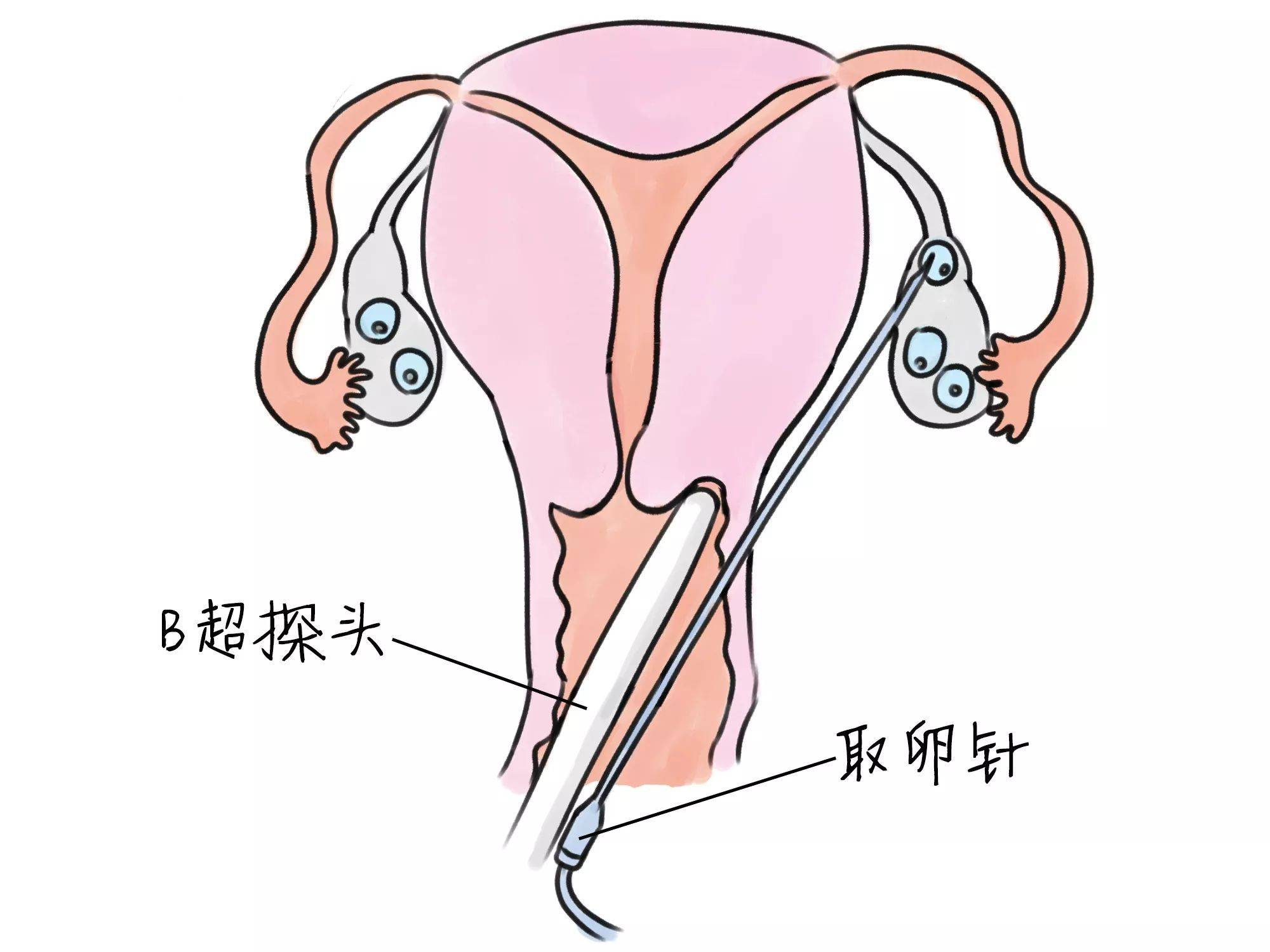 取卵后一个月的移植，希望与等待的旅程