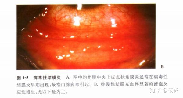 病毒性结膜炎持续一个月未愈怎么办？